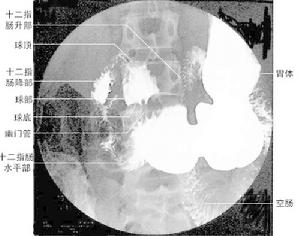 （圖）霍亂樣綜合徵