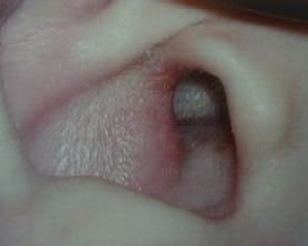 外耳道癤 外耳道癤