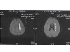 分水嶺區腦梗死 分水嶺區腦梗死