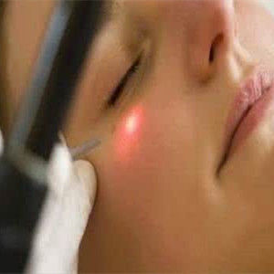 雷射祛斑 雷射祛斑