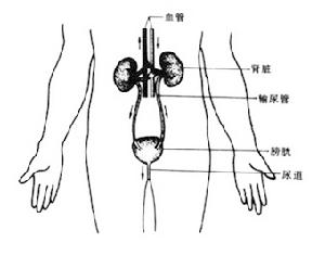 膀胱結石