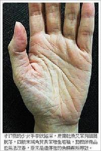 性聯魚鱗癬 性聯魚鱗癬