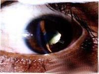 多發性硬化伴發葡萄膜炎 多發性硬化伴發葡萄膜炎