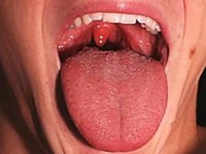 咽後壁淋巴濾泡增生