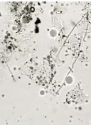 黴菌性外陰炎 黴菌性外陰炎