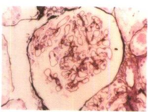 （圖）妊娠合併急性腎小球腎炎