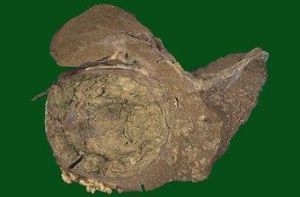 原發性膽汁性肝硬化 原發性膽汁性肝硬化