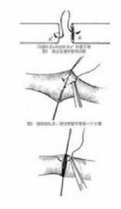 神經外膜縫合術 神經外膜縫合術