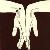 手腕隧道症 手腕隧道症