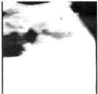 巨大肥厚性胃炎