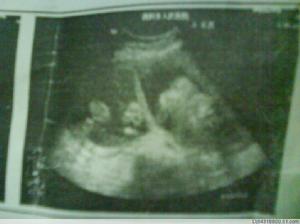 羊膜腔感染綜合徵