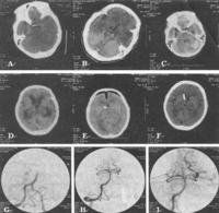 多發性腦梗死 多發性腦梗死