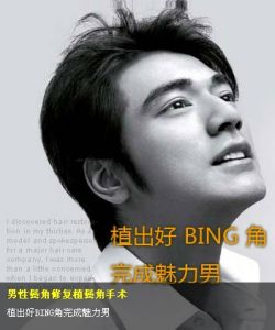 移植鬢角 移植鬢角