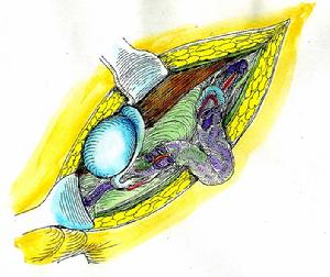 精索惡性腫瘤 精索惡性腫瘤