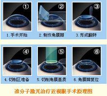準分子雷射治療屈光不正原理圖