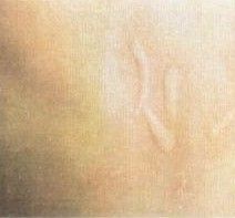 套用本品偶見蕁麻疹