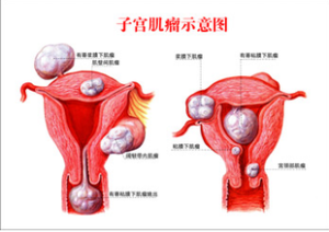 子宮肌瘤示意圖
