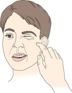 chvostek征 chvostek征