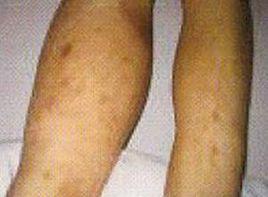 疼痛性股白腫 疼痛性股白腫