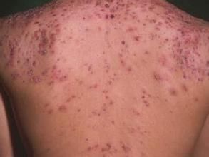 暴發性痤瘡 暴發性痤瘡