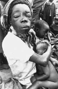 奧爾布賴特綜合症 奧爾布賴特綜合症