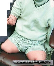 喪失勞動能力 喪失勞動能力