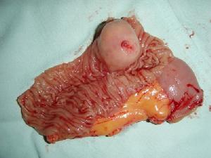 小腸腫瘤