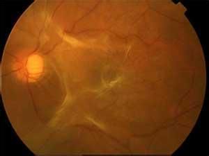 黃斑裂孔性視網膜脫離