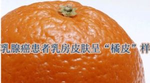 橘皮樣改變 橘皮樣改變