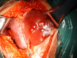 炎症性腹主動脈瘤