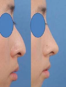 駝峰鼻及歪鼻修復術