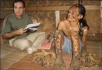 樹人[人類的一種皮膚病]