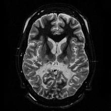 腎上腺腦白質失養症 腎上腺腦白質失養症