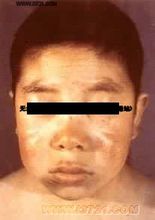 成人粘液性水腫