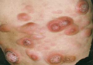 （圖）皮膚白血病