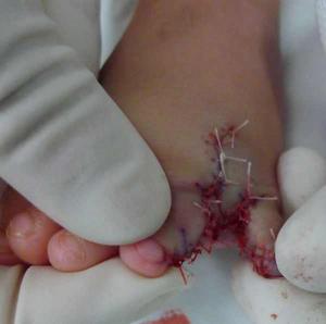 並指(趾)分開術 並指(趾)分開術