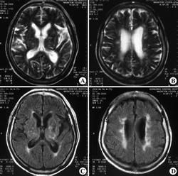 腦白質疏鬆症 腦白質疏鬆症