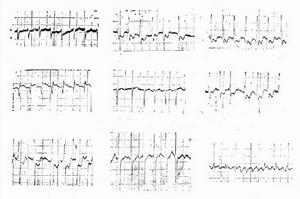 老年人心源性休克
