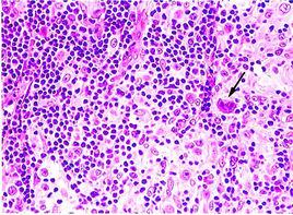 何金氏病 何金氏病