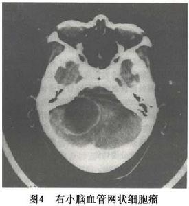 （圖）腦內血管網狀細胞瘤