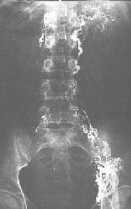 淋巴管阻塞 淋巴管阻塞