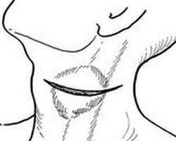 先天性喉裂 先天性喉裂