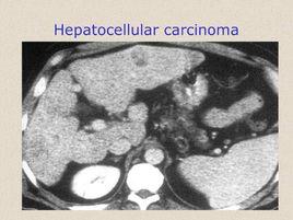 肝細胞性黃疸 肝細胞性黃疸