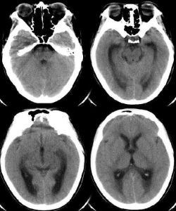 病毒性腦炎 病毒性腦炎