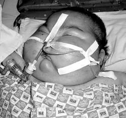 庫興氏綜合徵 庫興氏綜合徵