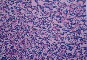 膀胱副神經節瘤 膀胱副神經節瘤