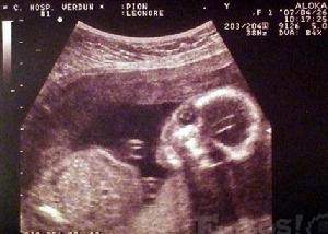 B型超音波檢查 B型超音波檢查