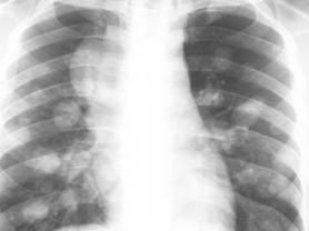 轉移性肺癌 轉移性肺癌