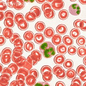 遺傳性球形細胞增多症