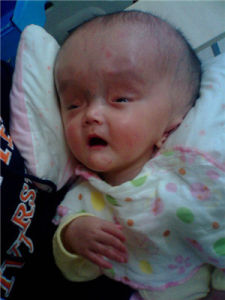 胎兒腦積水 胎兒腦積水